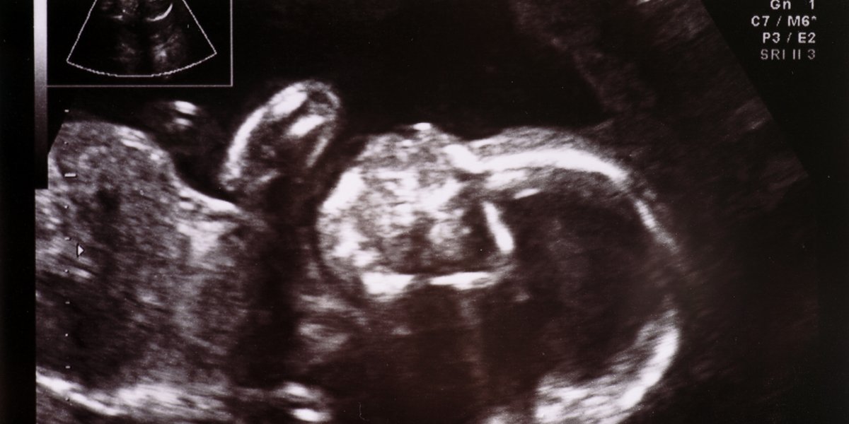 Ultraschallbild eines Ungeborenen