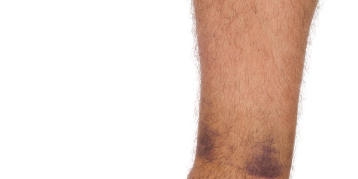 Bei starken Verstauchung können Blutgefässe unter der Haut beschädigt werden, was zu blauen Flecken führt