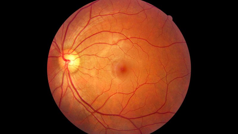 Abbild der Retina (Netzhaut)