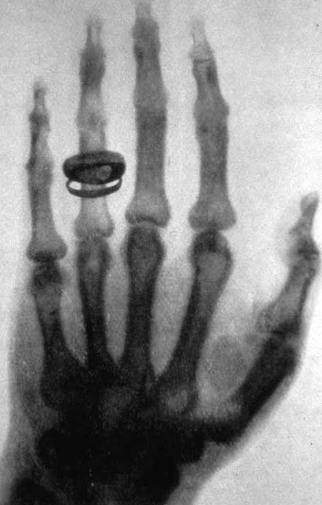Röntgenaufnahme einer linken Hand